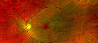 Retinal image