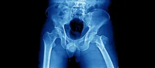 X-ray of a hip fracture