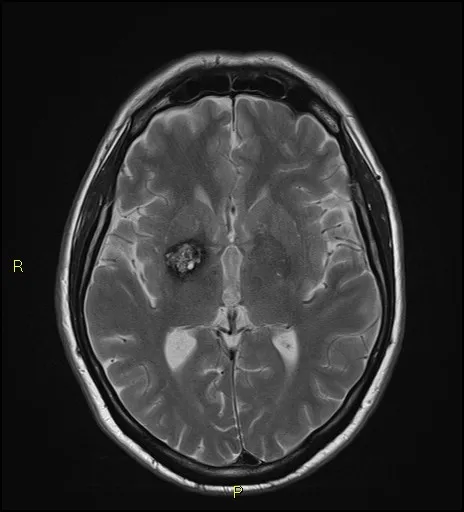 Image of Brain scan showing Cavernoma