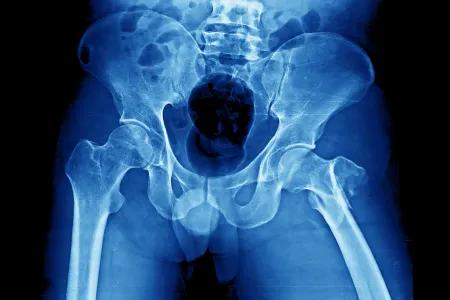 X-ray of a hip fracture